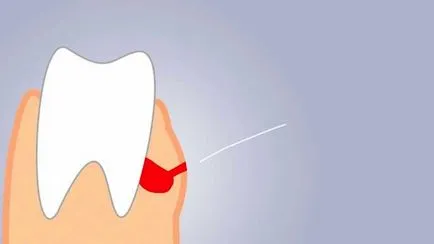Амвона - причини, симптоми и профилактика на зъбите пулпит