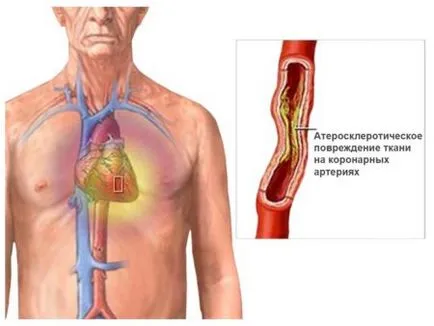 A korai infarktus utáni angina