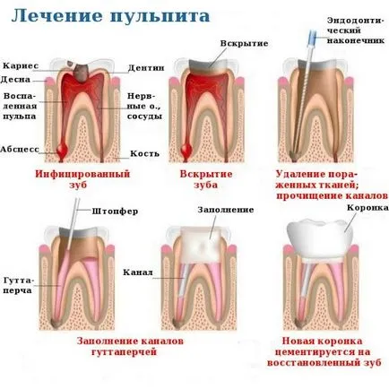 Amvon - cauze, simptome si prevenirea pulpitei dintelui