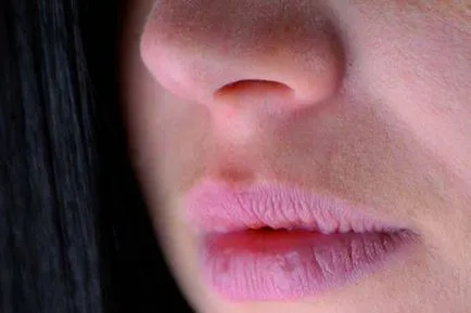 Izgató a sarkokban az ajkak okait és sebek kezelésére és repedések
