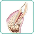 umplerea canalului radicular retrogradă