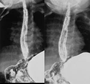 Esofagita de reflux simptome, clasificare, cauze, diagnostic, tratament, complicații, ICD-10, fotografii