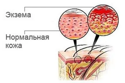 Предписание за лечение на екзема бреза катран