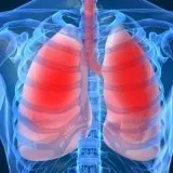 boala pulmonară obstructivă cronică, tratament - bisturiu - medical