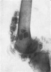 chondromatosis genunchi simptome articulare, tratament