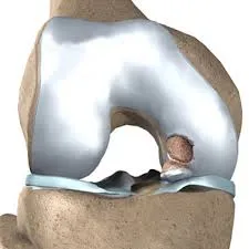 chondromatosis genunchi simptome articulare, tratament