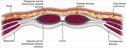 Хирургично лечение на постоперативни херния използвайки окото импланти - хирург