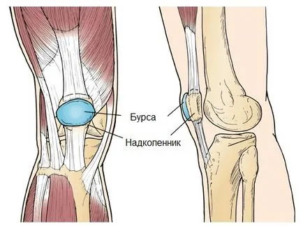 chondromatosis térdízület tünetei, kezelése