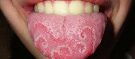 Напукването език и неговите опасности, причини и лечения на болестта