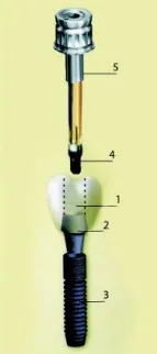 O metodă de protezare temporară perioada osteointegrării implant dentar