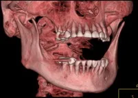 Модерна компютърна томография за стоматология
