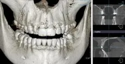 Модерна компютърна томография за стоматология