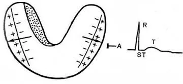 Subendocardialis ischaemia az EKG