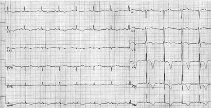 Subendocardialis ischaemia az EKG