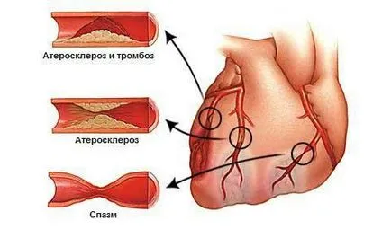 Subendocardialis ischaemia az EKG