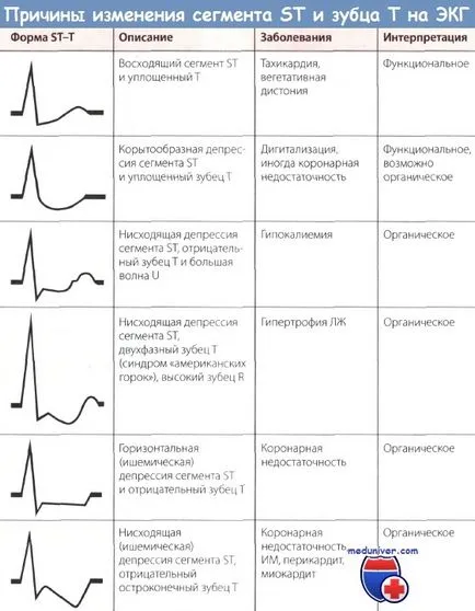 ischemie miocardică subepicardial