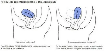 Curl uterului și sarcinii, uterul in timpul sarcinii