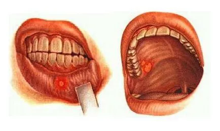 boli orale la copii