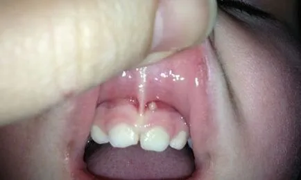 boli orale la copii