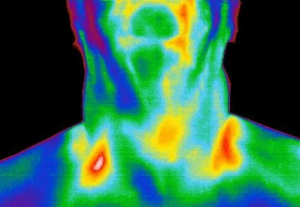термография на щитовидната жлеза
