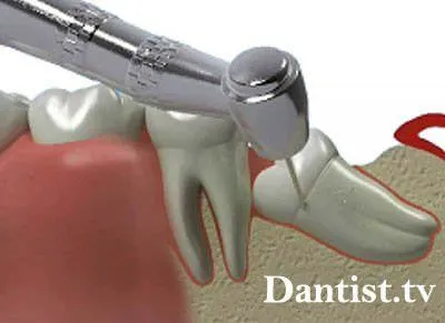 Премахване на мъдрост цена и снимки на зъбите