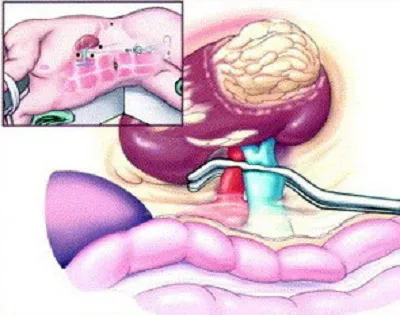 Prin îndepărtarea rinichiului (nefrectomie), perioada postoperatorie și efectele operației