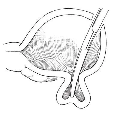 Eltávolítása diverticulum hólyag