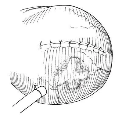 Eltávolítása diverticulum hólyag