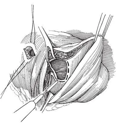 Eltávolítása diverticulum hólyag