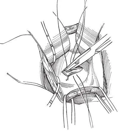 Eltávolítása diverticulum hólyag