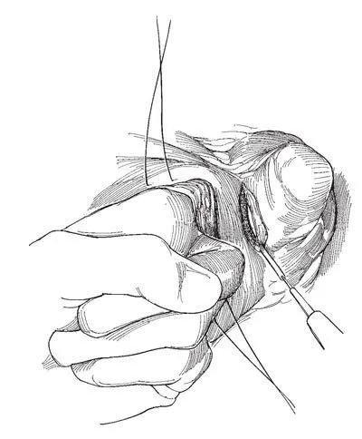 Eltávolítása diverticulum hólyag