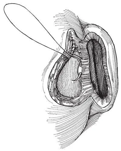 Eltávolítása diverticulum hólyag