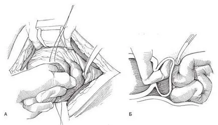 Eltávolítása diverticulum hólyag