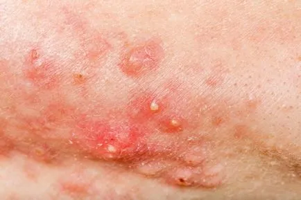 A súlyos formája az acne és fotó grade 3 kezelés