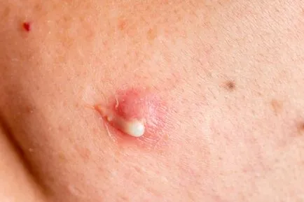 A súlyos formája az acne és fotó grade 3 kezelés