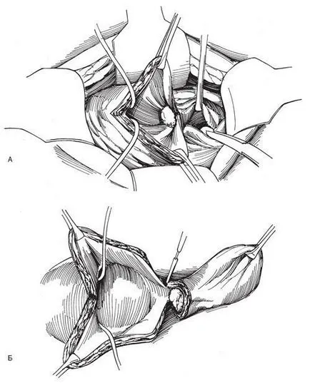 Eltávolítása diverticulum hólyag