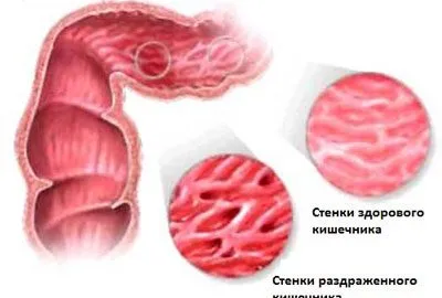 В кърмачки диария какво да правя, отколкото да се лекува