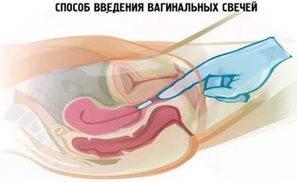 Вагинални свещички херпес приложение и дозиране