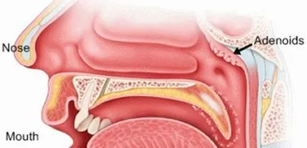 Efectul adenoidectomia asupra dezvoltării copilului