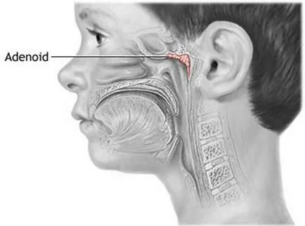 Efectul adenoidectomia asupra dezvoltării copilului