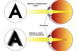 astigmatism congenital