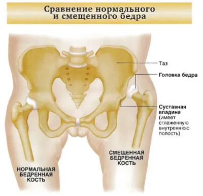 Вродена хип лечение дислокация снимка