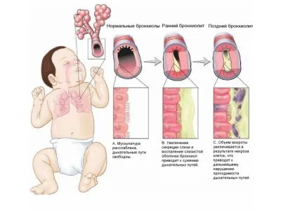 Șuierătoare într-un copil cu respirație în nas și gât, și o tuse care face