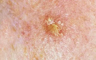 Aktinikus keratózis (szoláris keratosis) kezelésére és profalaktika, beautyinfo