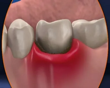 abcese dentare - Tratamentul, cauze, complicații ale înțelepciunii abcese dentare