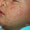 Алергия при новородени причини, симптоми, лечение и снимки