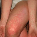 Алергия към латекс - симптоми, лечение, както и снимки на жени, мъже и деца