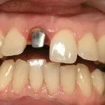 All-on-4 tehnologia protetică dentară 