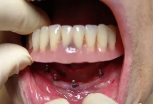 Алтернатива на зъбни импланти