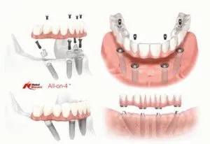 All-on-4 tehnologia protetică dentară 